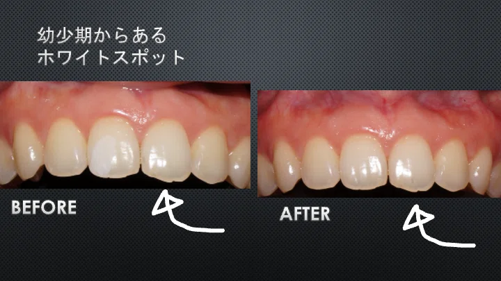 「その前歯の白濁、いきなり治すと損します。」ホワイトスポットは「削る」前に「白く」しろ。専門医が教える逆転の治療メソッド｜歯の美容室 ...