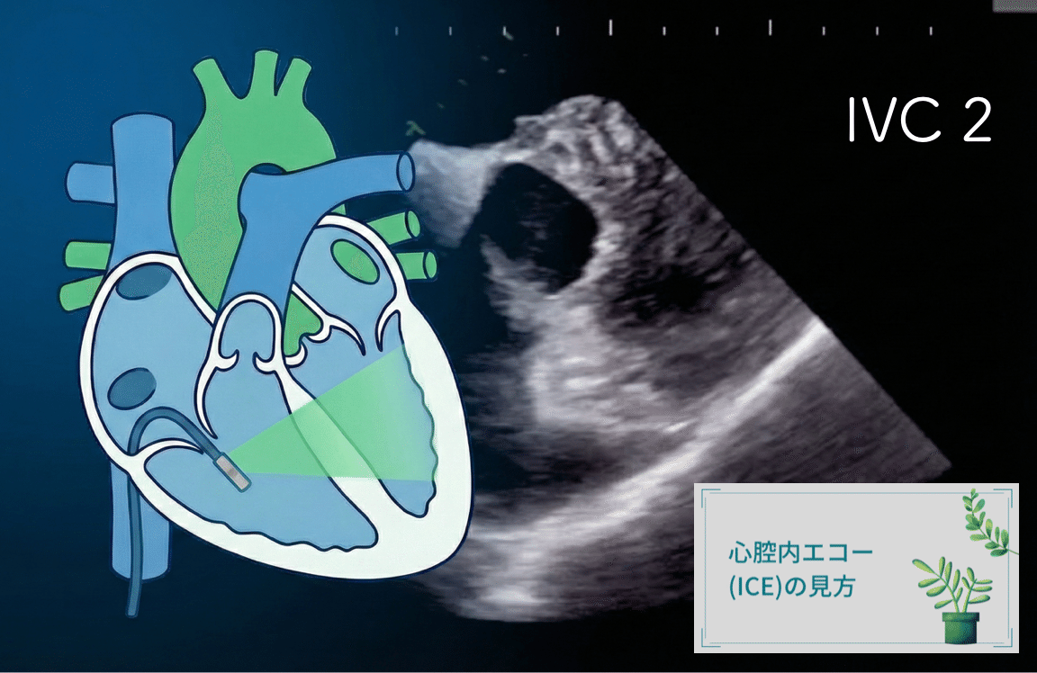 動画解説】心腔内エコー（ICE）操作の基本とコツ 〜SOUNDSTARとCARTO3の連携〜 心房編｜Comprehensive Arrhythmia  Management Institute