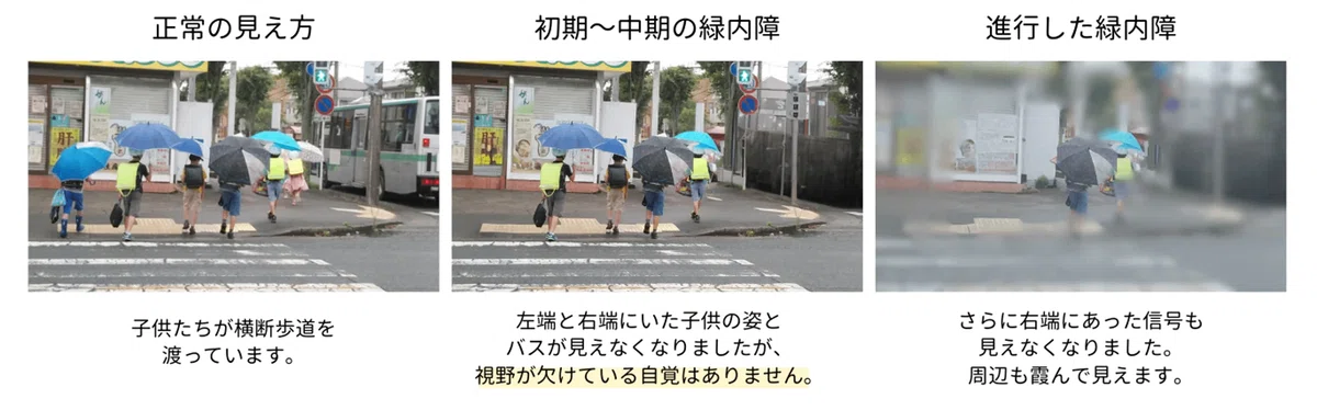 視野が欠ける 緑内障など|九州ビジョンサポート