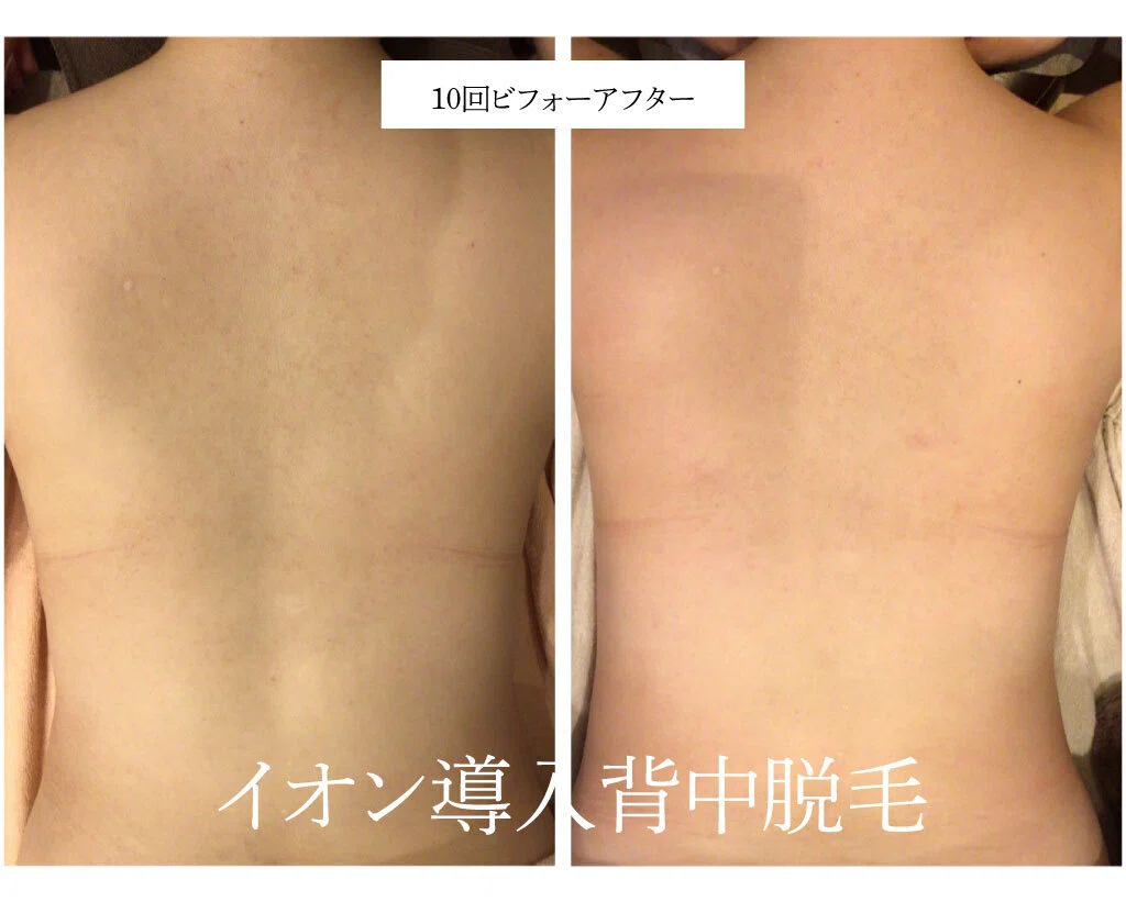 【背中脱毛】背中ニキビケアにも シェービング付☆|うなじ脱毛・背中脱毛│Lino【堀江】