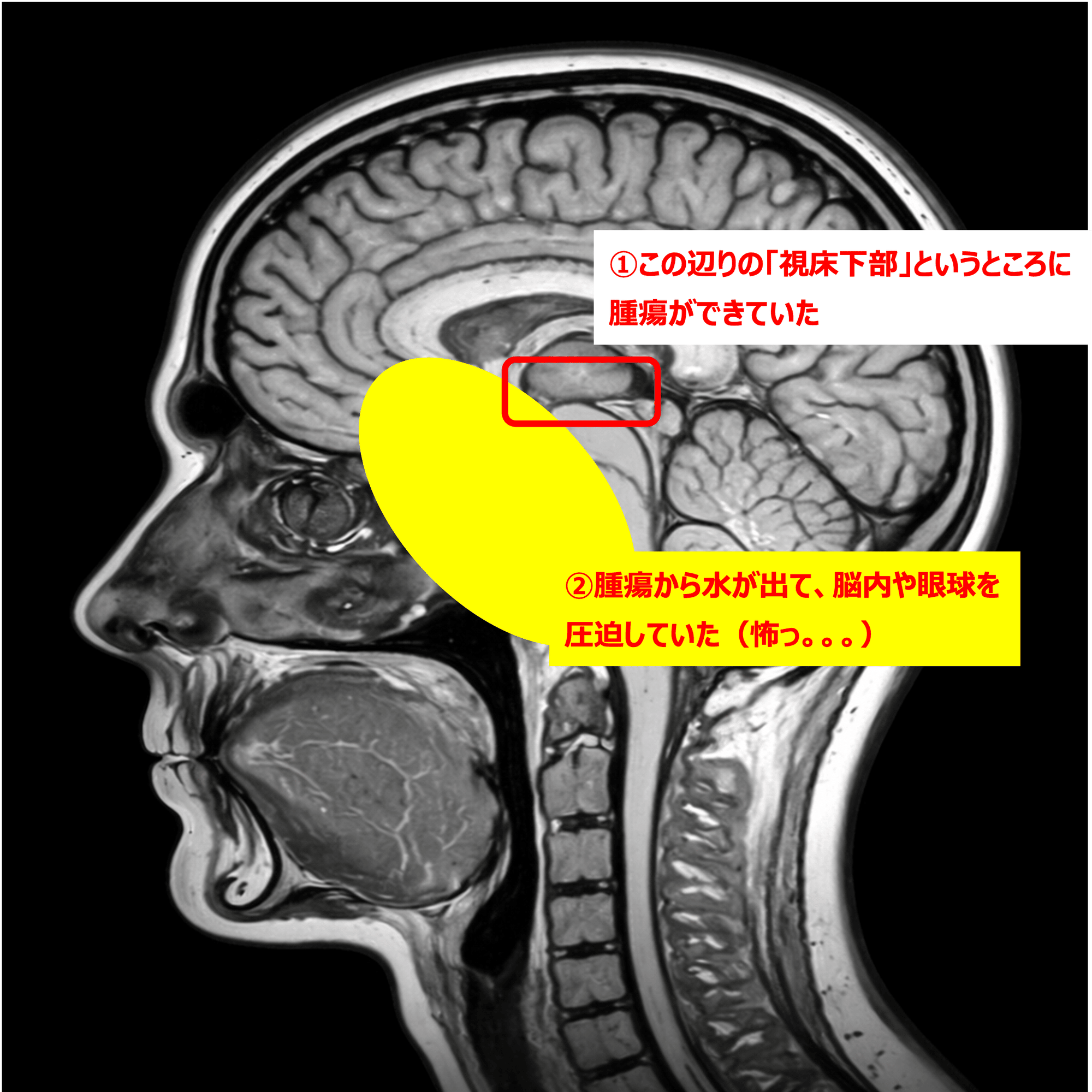 回顧録】20歳を前にしてようやく初めてのインフルエンザ感染かと思っ