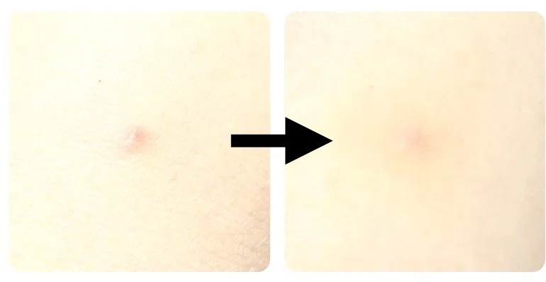 Acne Filter Effect How to deal with sudden acne|メイク研究家 智恵子