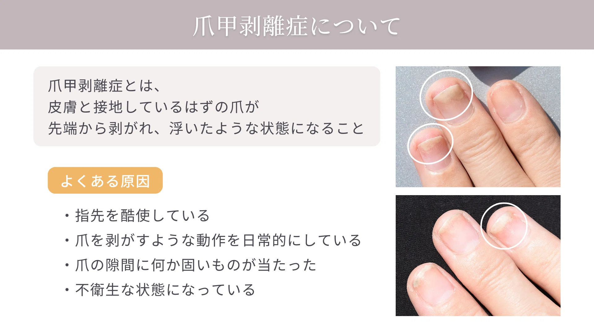 爪 甲 剥離 症 原因