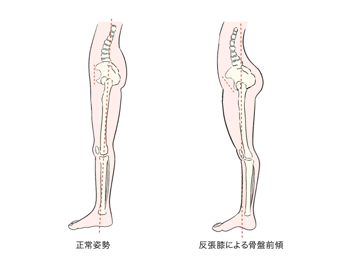 【元インソール職人が語る】膝が「反る」と、全身が歪む理由。｜金子 來（kaneko rai）