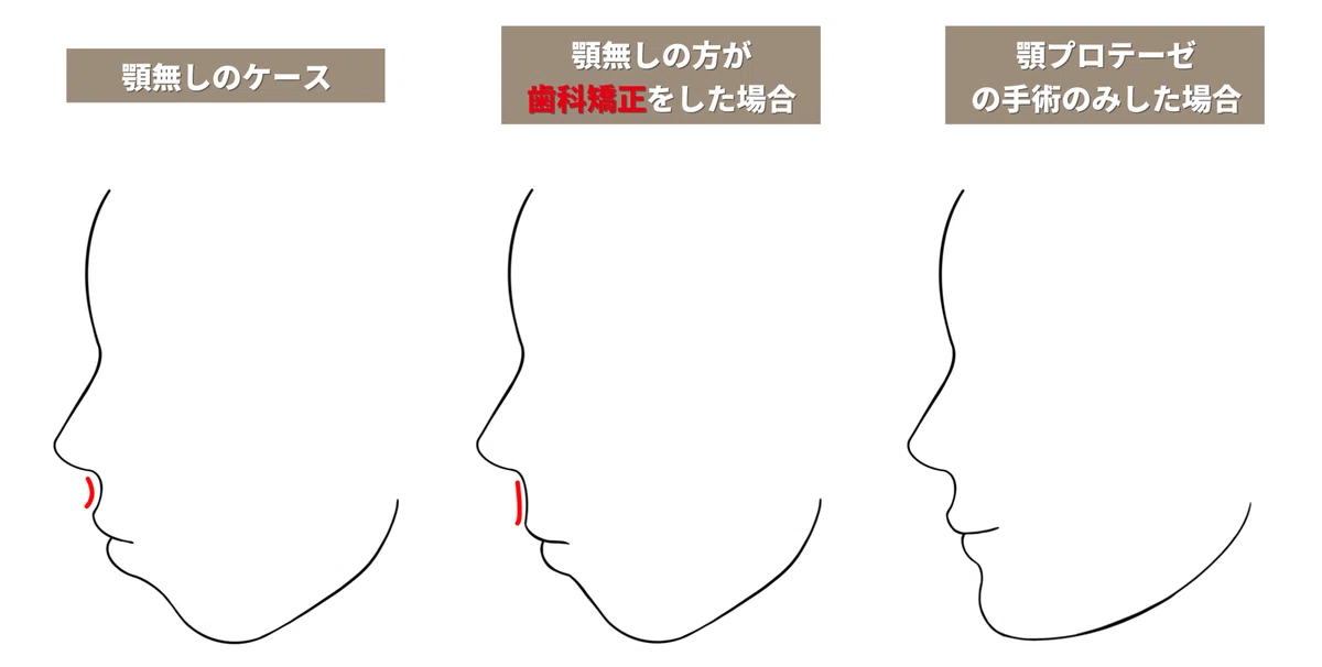 【顎無】顎プロテーゼの総まとめ|ザ·ビダン美容外科