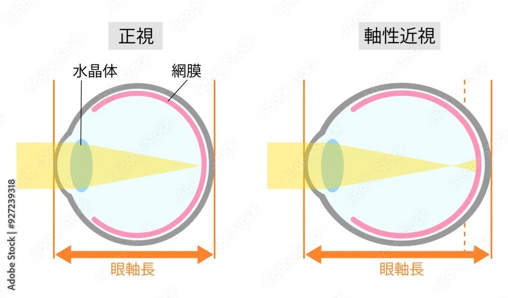 6th Can Myopia Be Cured The Front Line Of Pediatric Myopia 6th-can-myopia-be-cured-the-front-line-of-pediatric-myopia