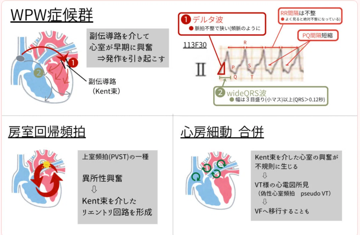 国試頻出】 【頻脈性不整脈 心電図解説】 ~医師国試過去問分析第2回「心電図の確実な得点を目指す」~【リーフェ医学情報】|リーフェ医学情報 ...