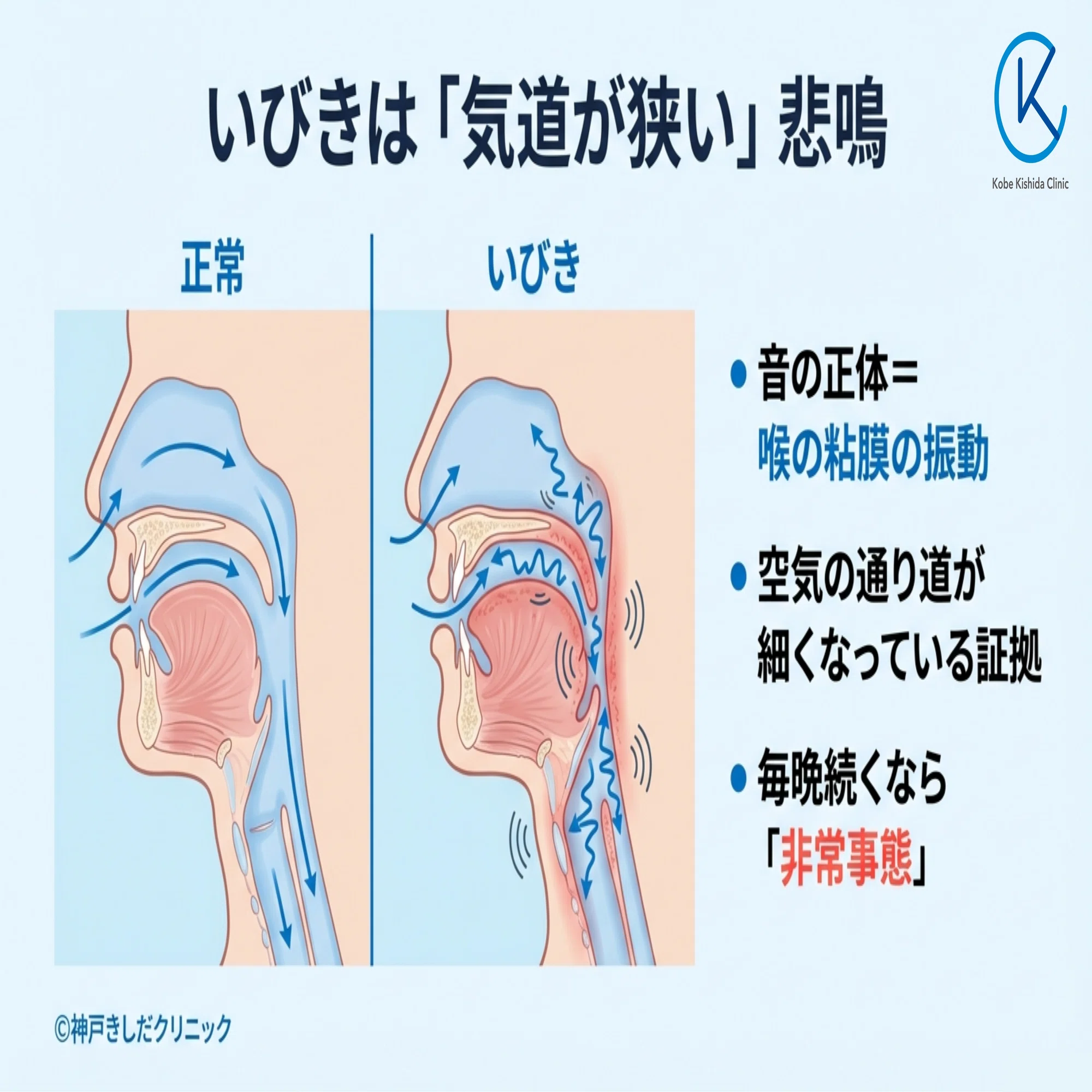 いびき 扁桃 腺