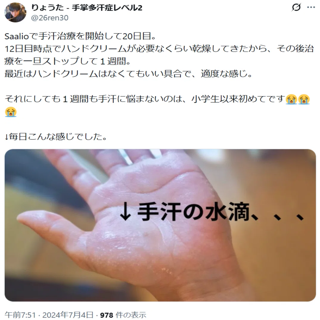 体験記】手汗に悩む私が自宅で続けた対策 ～約70日間のリアルな記録 