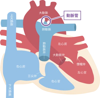 Krichenko 動脈管開存症(PDA:patent ductus arterious)|心ねこーまる