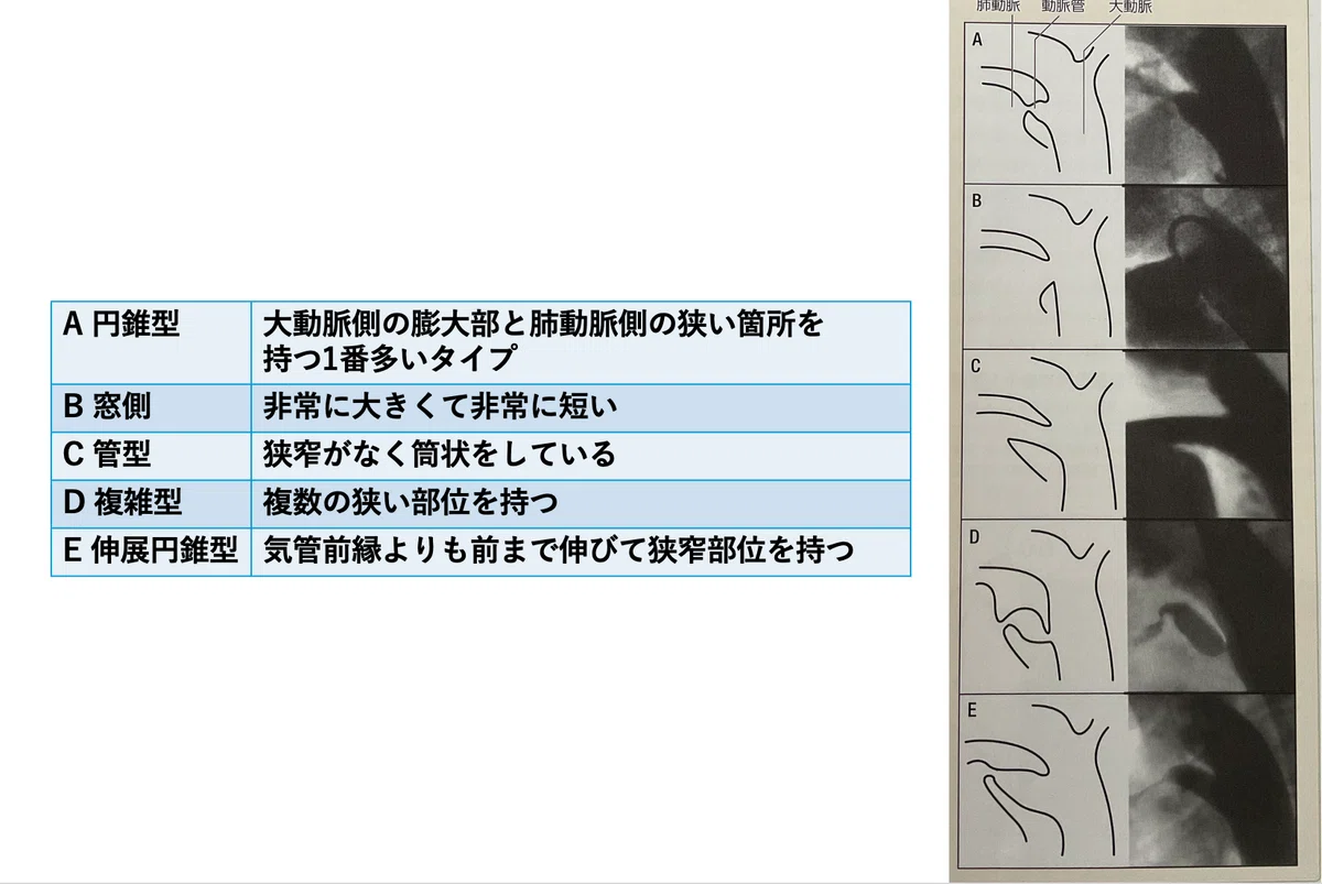 Krichenko 動脈管開存症(PDA:patent ductus arterious)|心ねこーまる