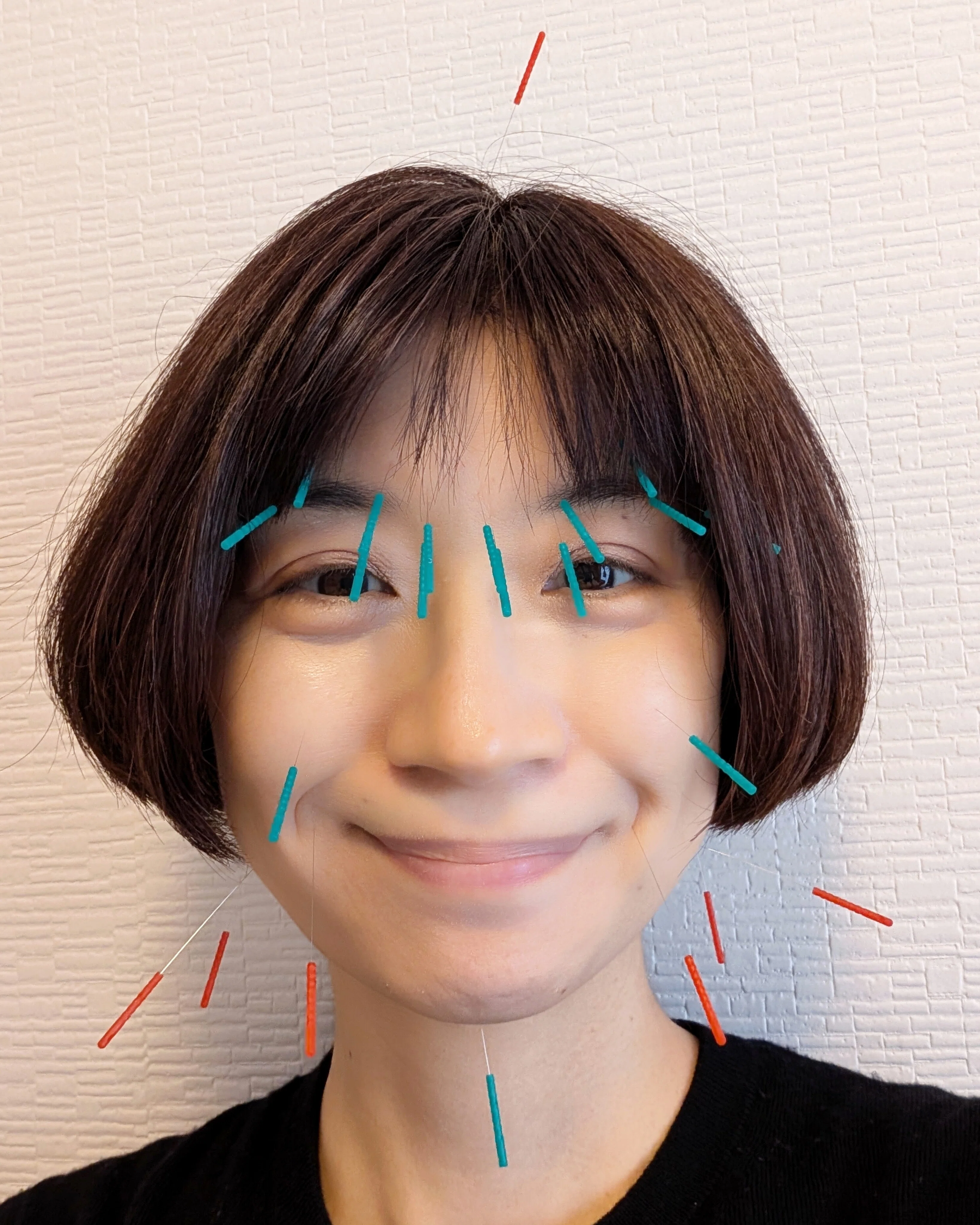 何歳からでもキレイになれる♡美容鍼で疲れ顔から復活！｜美容鍼灸