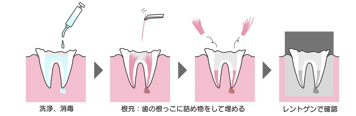 根幹治療した歯を抜いた話|かいと