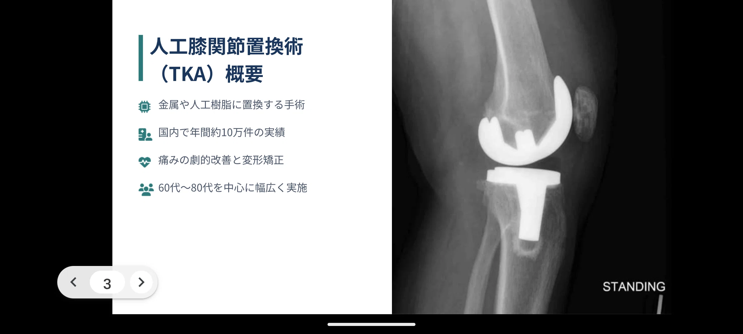 理学療法士が作成：市民講座でそのまま使える『人工膝関節置換術と術後
