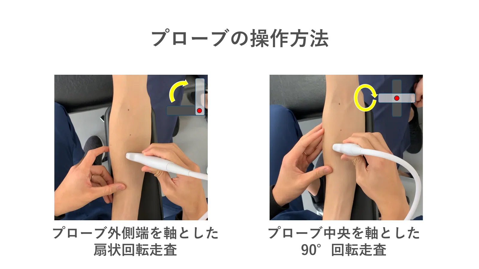 定期購読版】肩関節のエコー（腱板・靭帯・関節包・神経などの見方