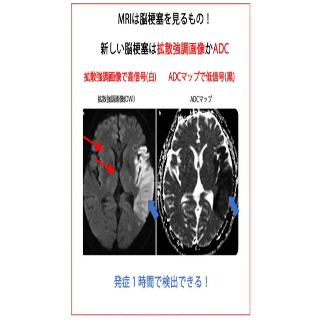 第61回理学療法士国家試験 午後11−15の解説｜Sixty_valleyのページ