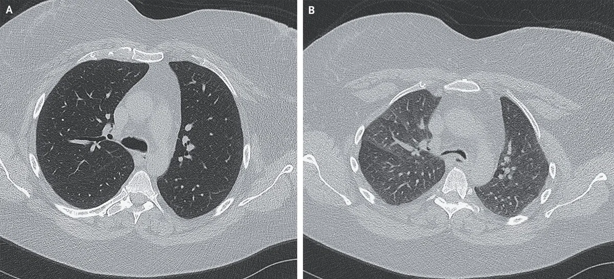 呼気時中枢気道虚脱(expiratory central airway collapse: ECAC)|Makisey