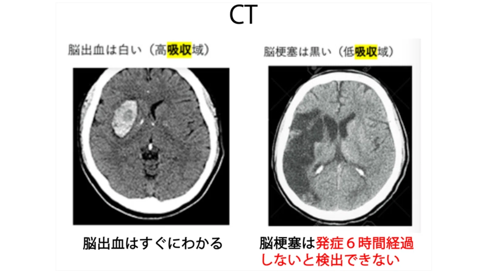 第61回理学療法士国家試験 午前86−90の解説｜Sixty_valleyのページ