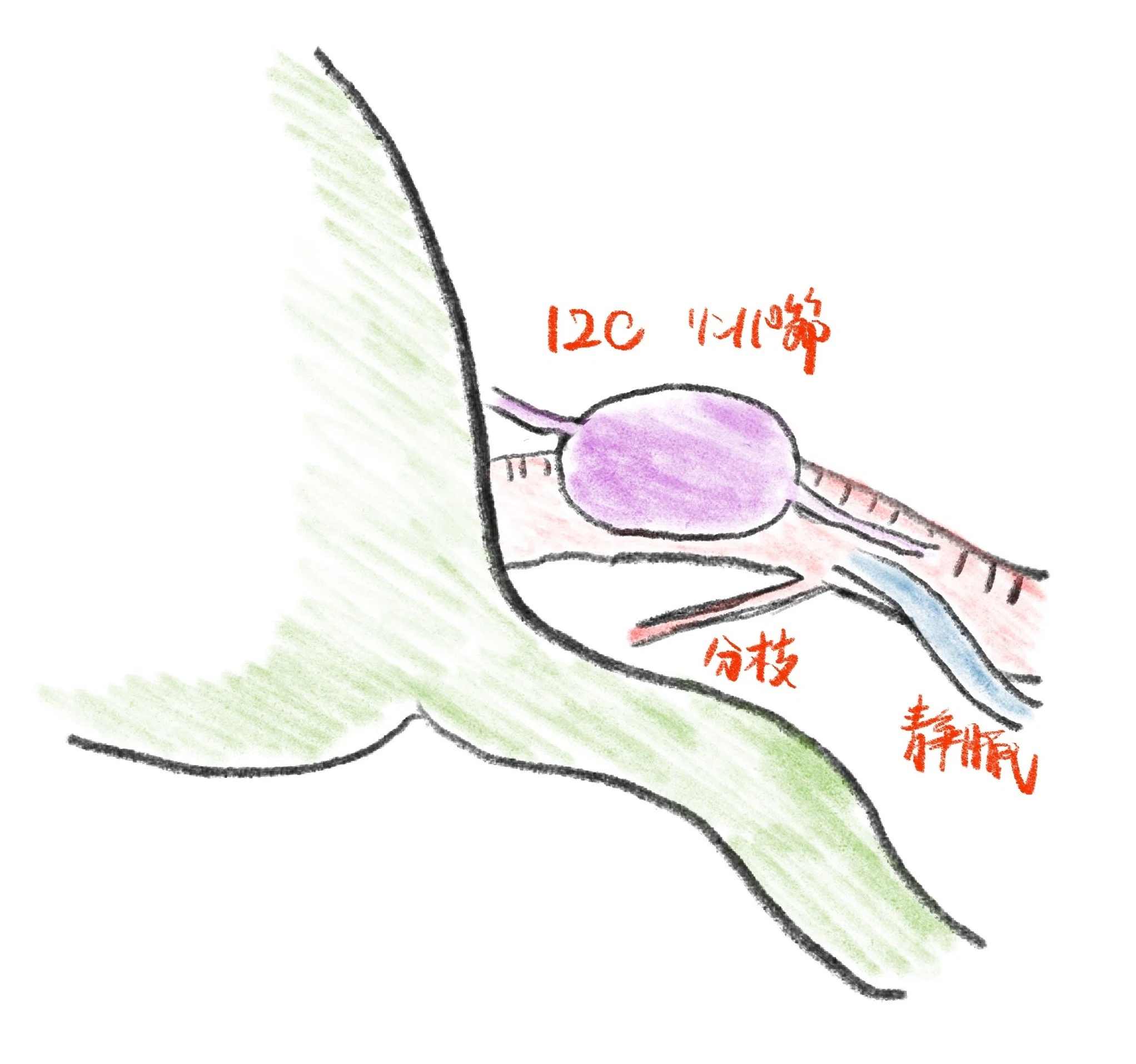 腹腔鏡下胆のう摘出術のコツ｜レジデントが最初に知っておきたい実践