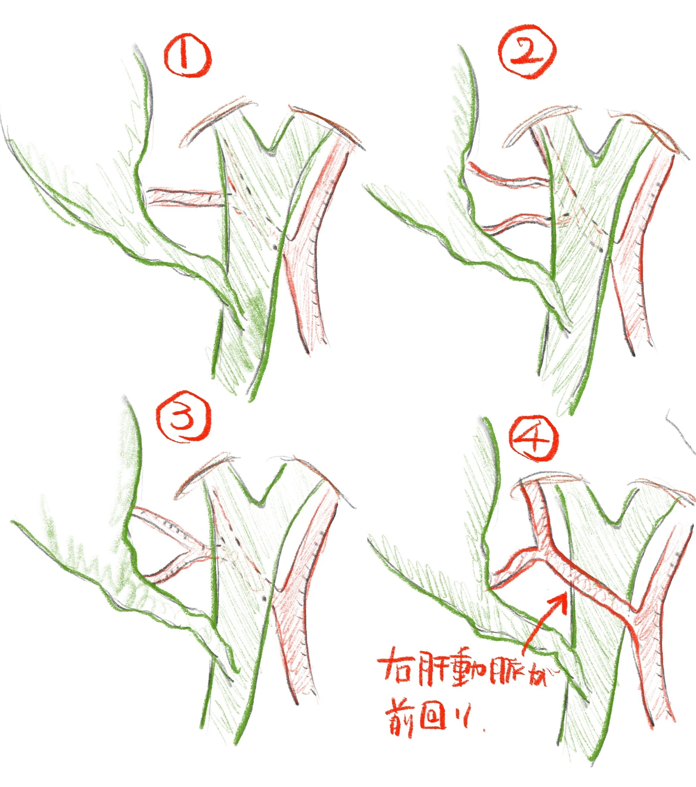 腹腔鏡下胆のう摘出術のコツ｜レジデントが最初に知っておきたい実践