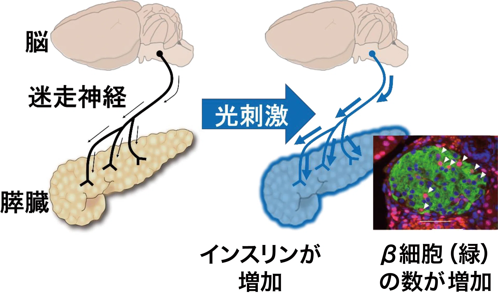 糖尿病を「臓器間ネットワーク」で克服へ 採血なしで発症超早期に予測