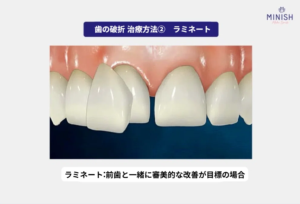 歯が欠けた、どのような治療を選択するのが良いか？メリット