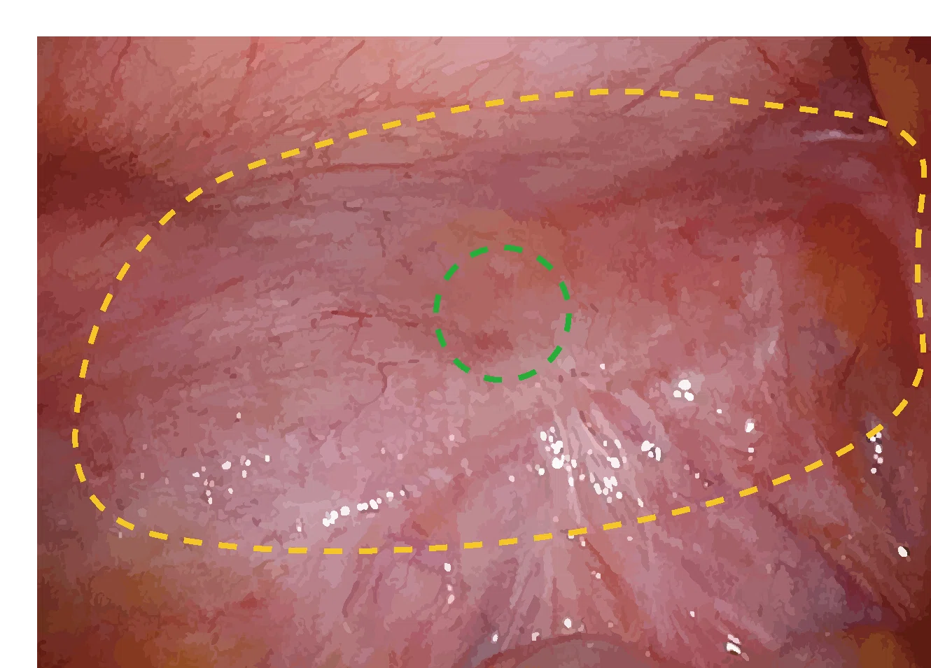 What happens during inguinal hernia surgery? | Where is the mesh