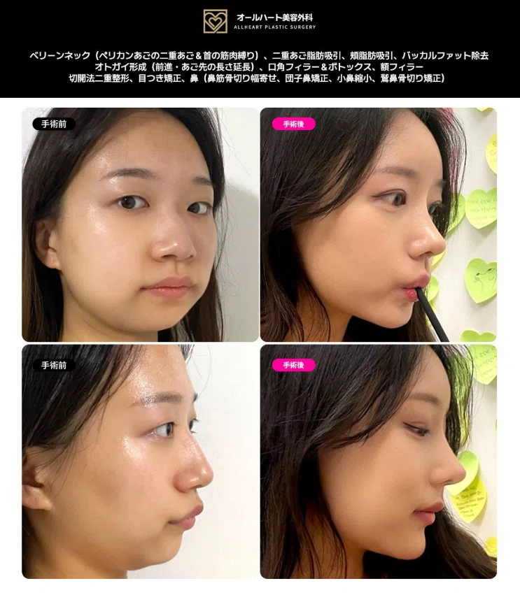 「魚顔(フィッシュフェイス)」原因と改善方法について|オールハート美容外科