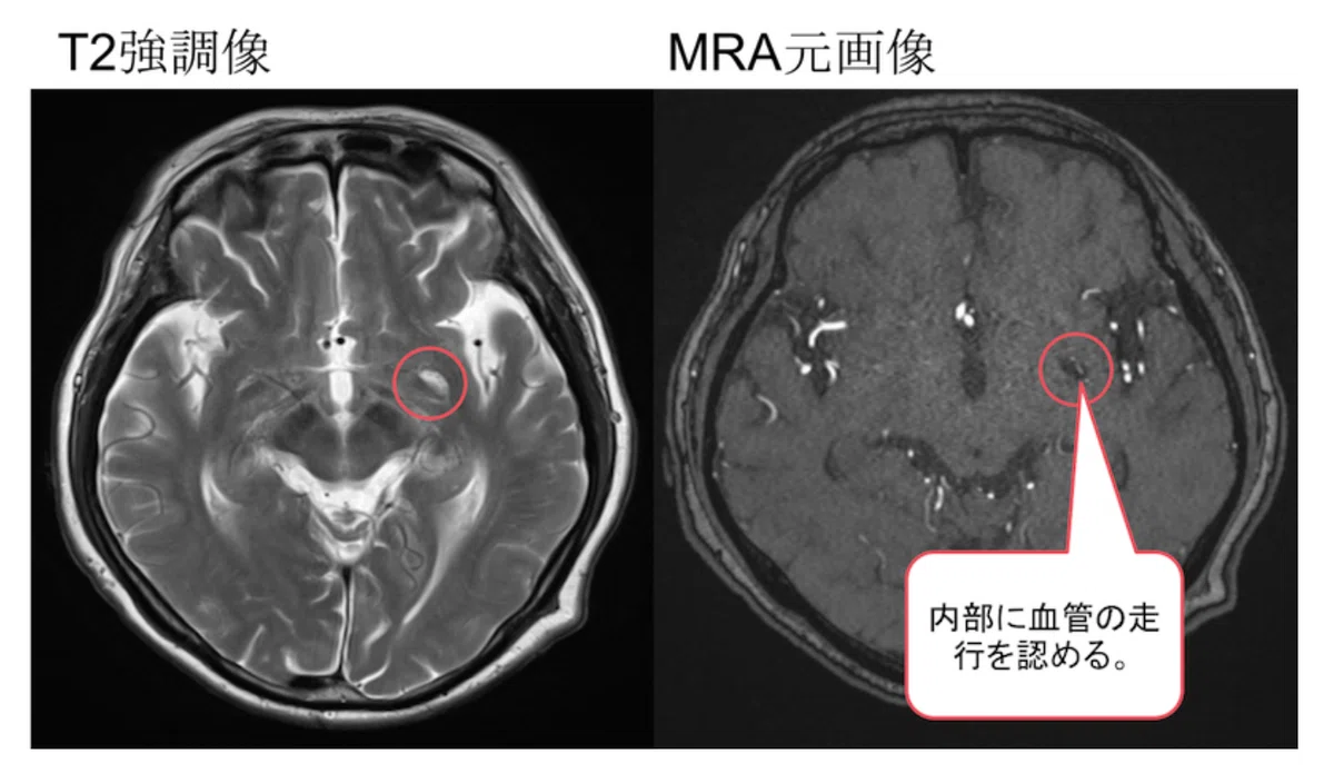 陳旧性脳梗塞と誤診しない！血管周囲腔のMRI画像所見のポイント