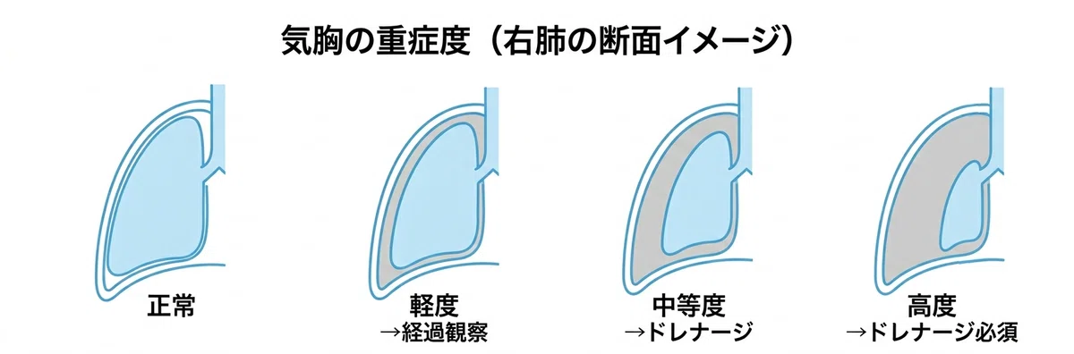 「肩こりかな」と思っていたら、肺が萎んでいた——気胸の基礎知識|じゃすみん