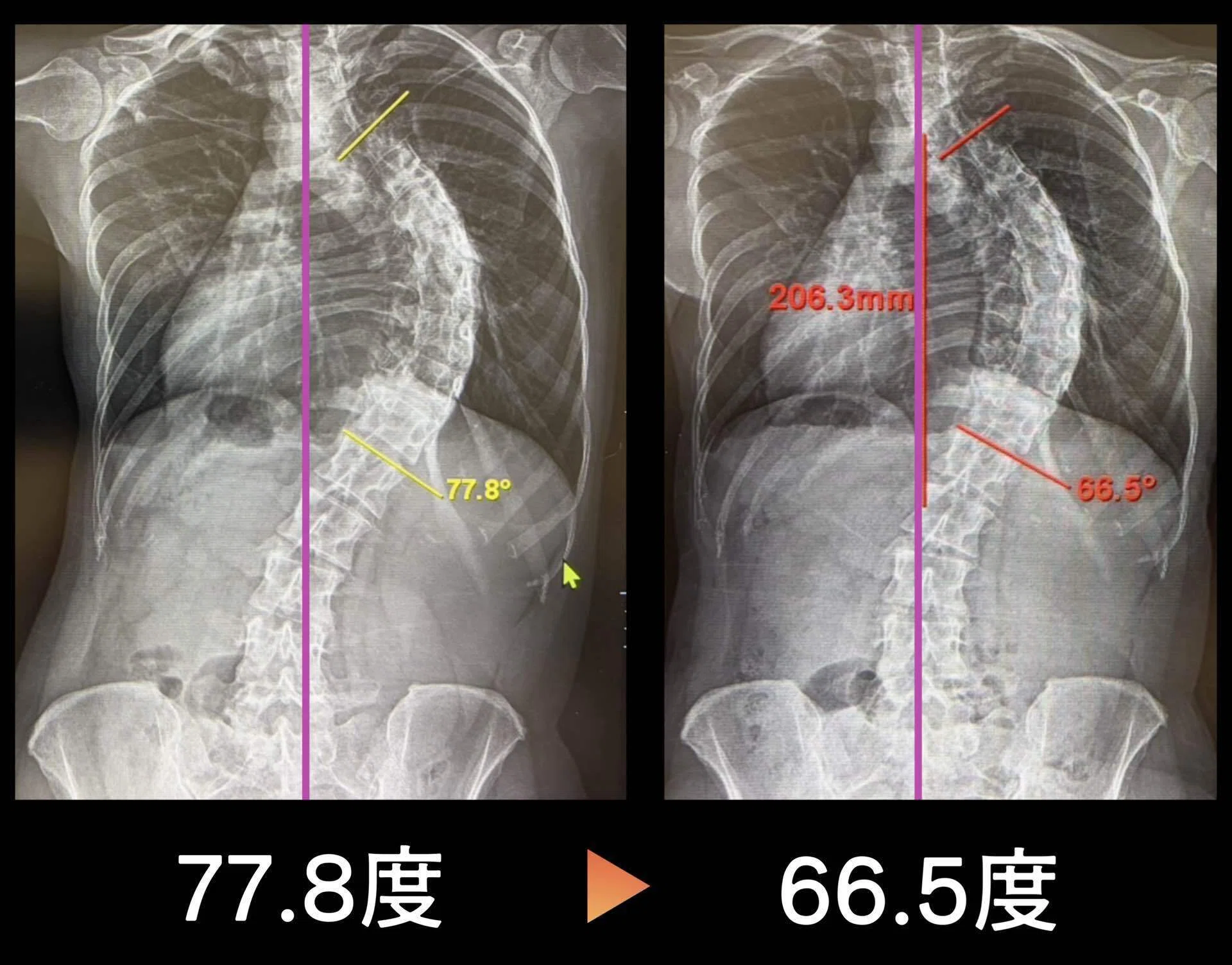 側弯症】49日間で77.8度から66.5度へ−11度改善！(側弯症手術見送り