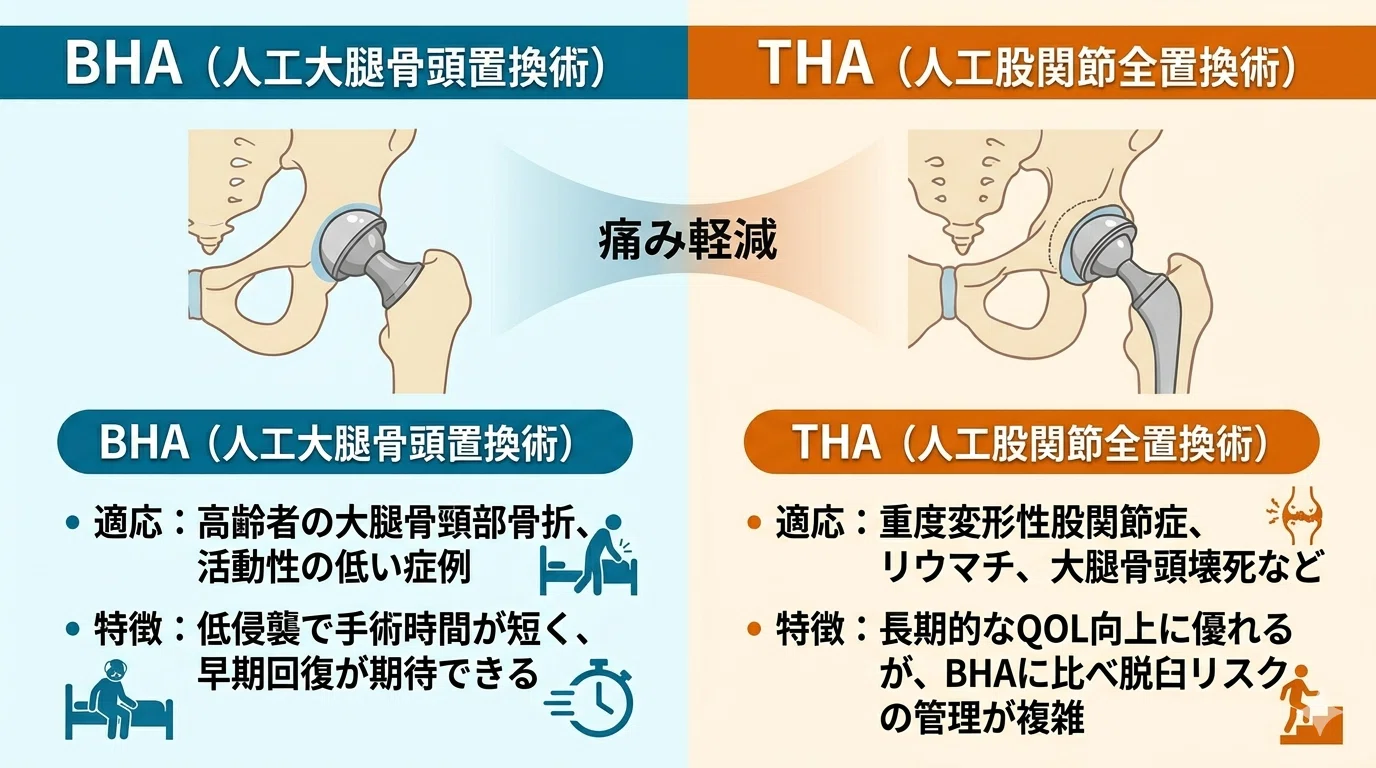 最小侵襲アプローチで究めるTHA・BHA: 最小侵襲アプローチで究めるTHA