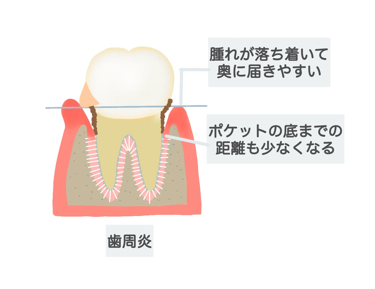 進行した歯周病とは？①軽度歯周炎の治療について｜湊城｜歯科衛生士の語り