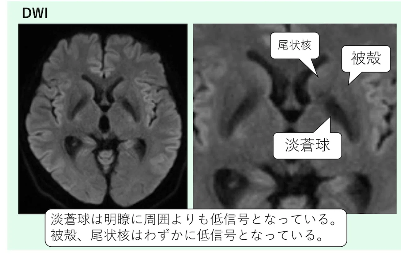 脳MRIのDWIで「黒く見える場所」とその理由！見逃しやすい正常低信号を