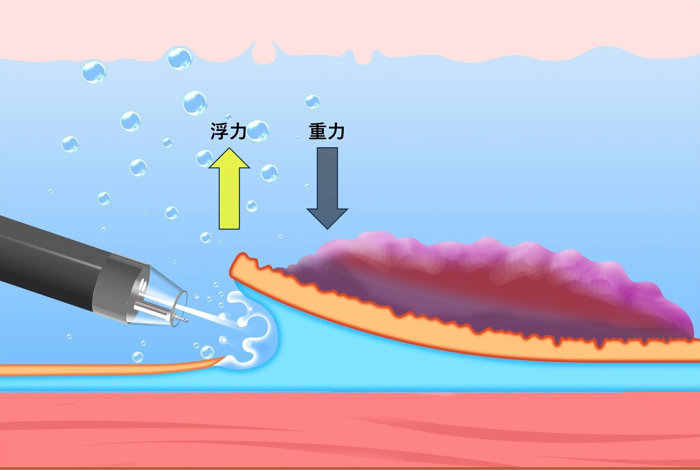 Underwater ESDは本当に優れているのか？ドイツのデータが示した“意外