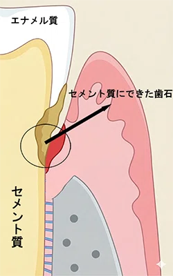 歯周炎になり歯槽骨やシーピー繊維が破壊され、セメント質に歯石が出来た状況を表した画像