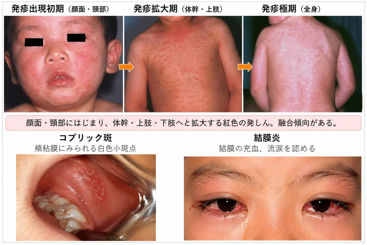 最近話題の「麻疹(はしか)」について|佐野隆友