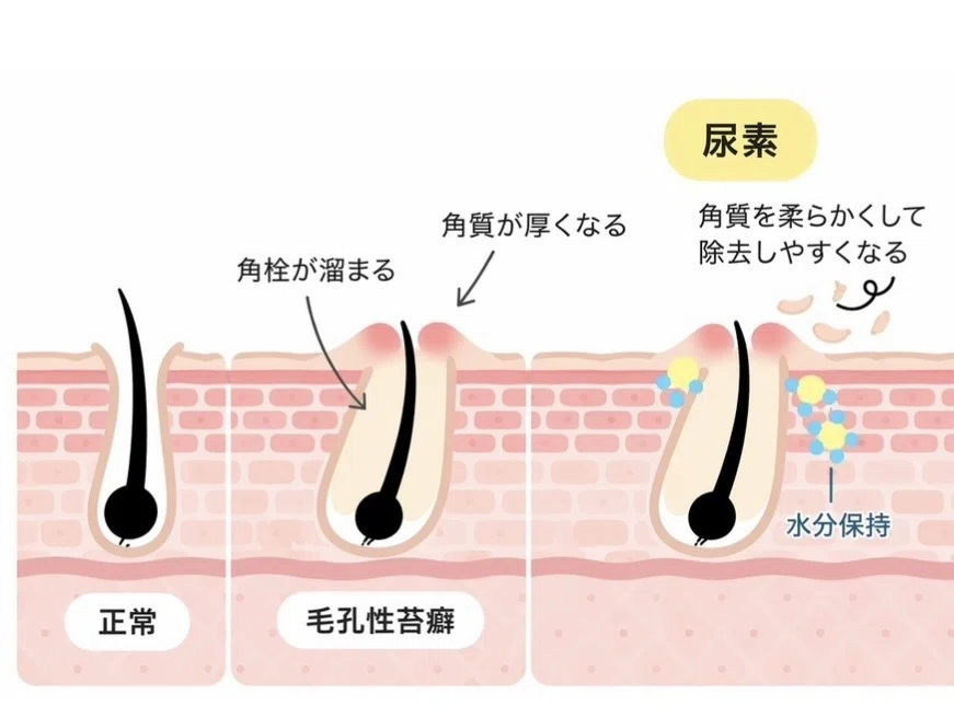 無料公開中】💡⟡.·100万課金美容ナースが教える二の腕ブツブツの