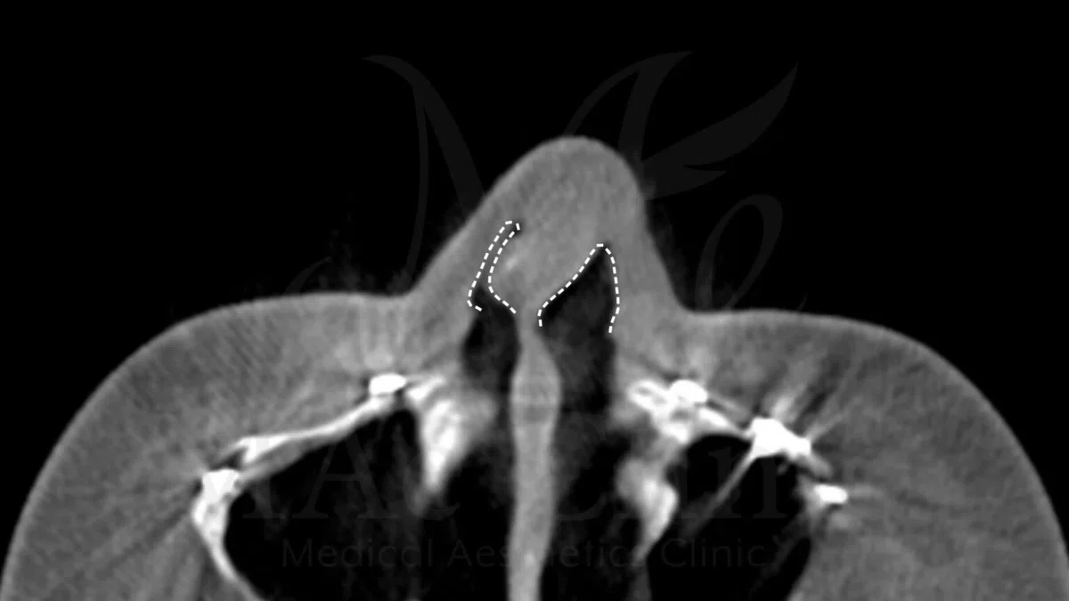 Sinus Scan Why We Take a CT Scan Before Rhinoplasty | Visualizing Internal Bone ...