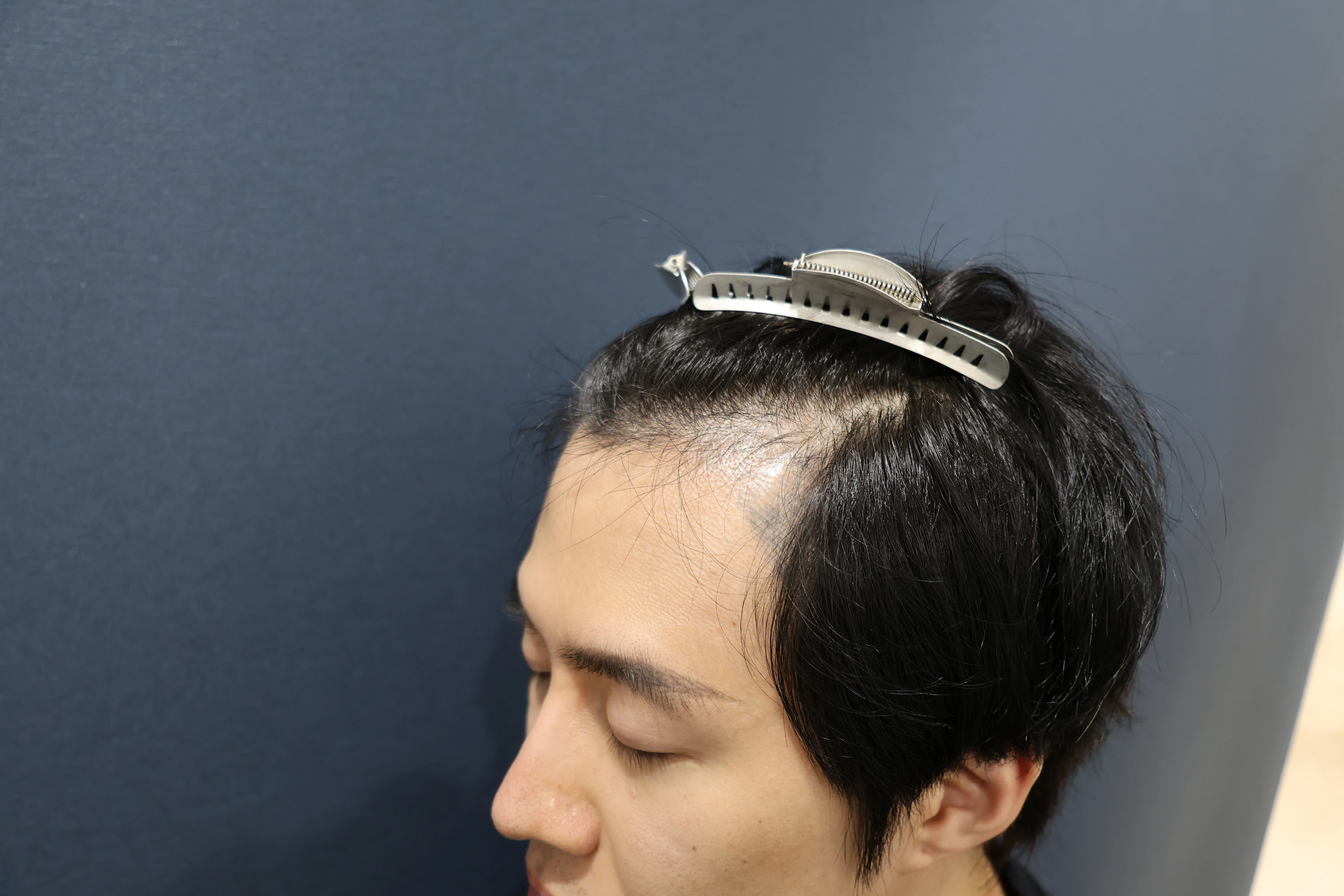 カノックスターさん（カノさん）の植毛手術 Part2 〜結果は如何に