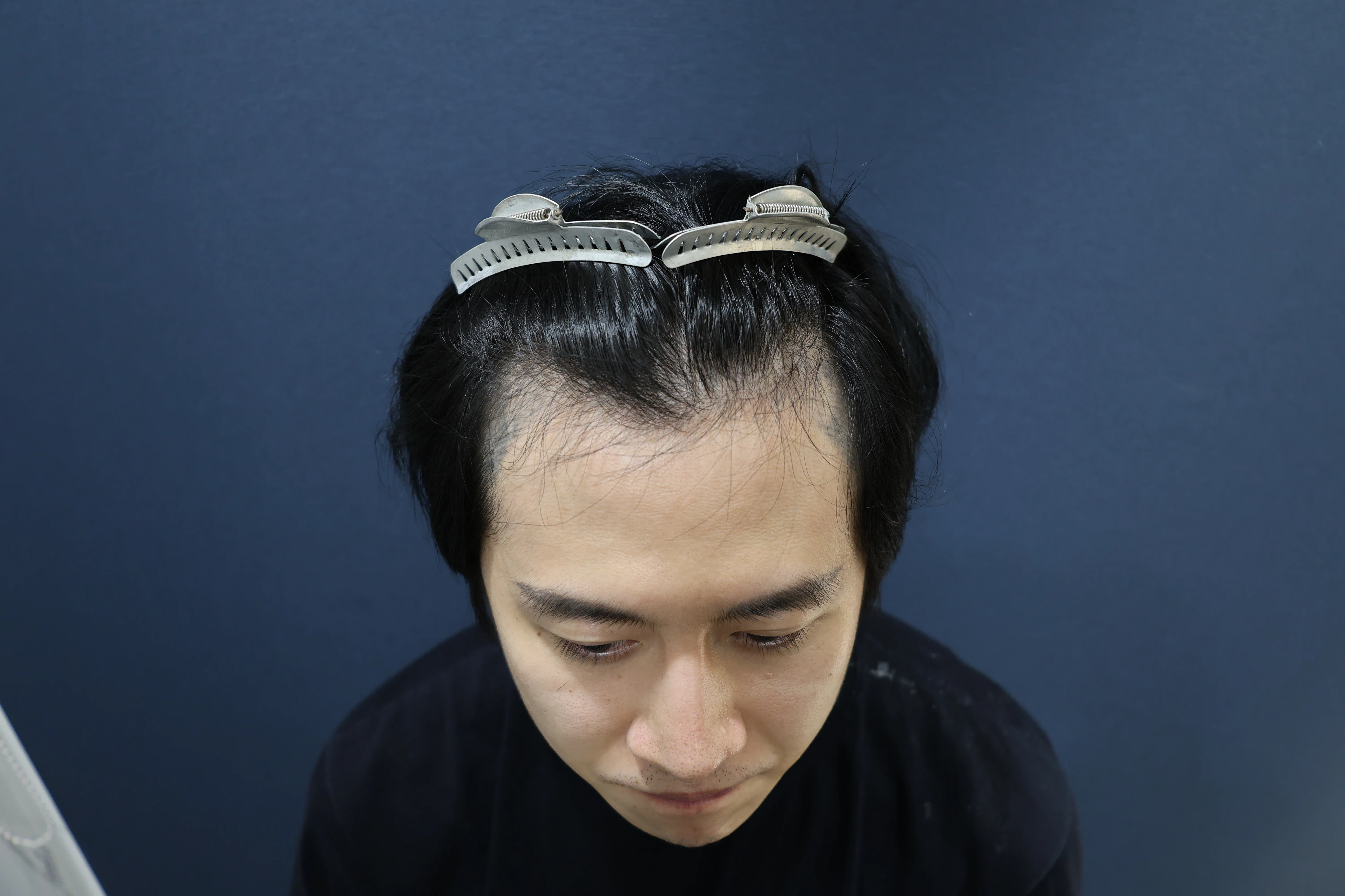 カノックスターさん（カノさん）の植毛手術 Part2 〜結果は如何に