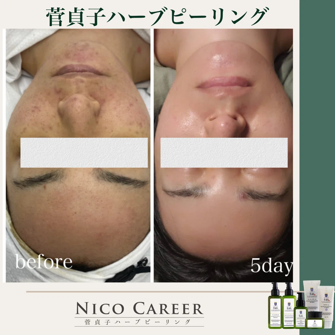 講習］菅貞子ハーブピーリング｜Maiko｜CAREER Academy