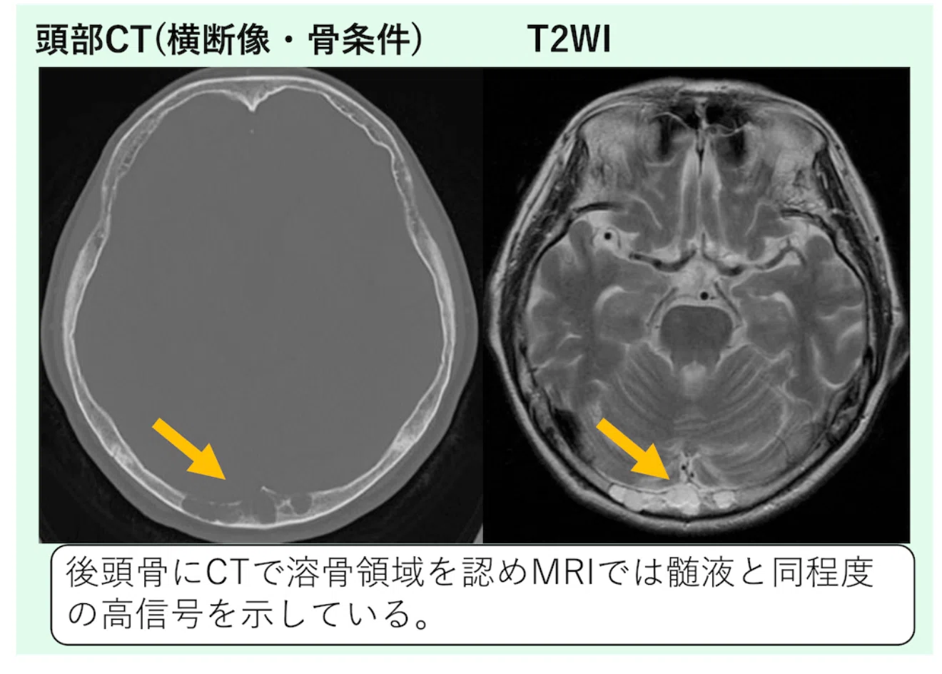 What are 'arachnoid granulations' incidentally found on head CT