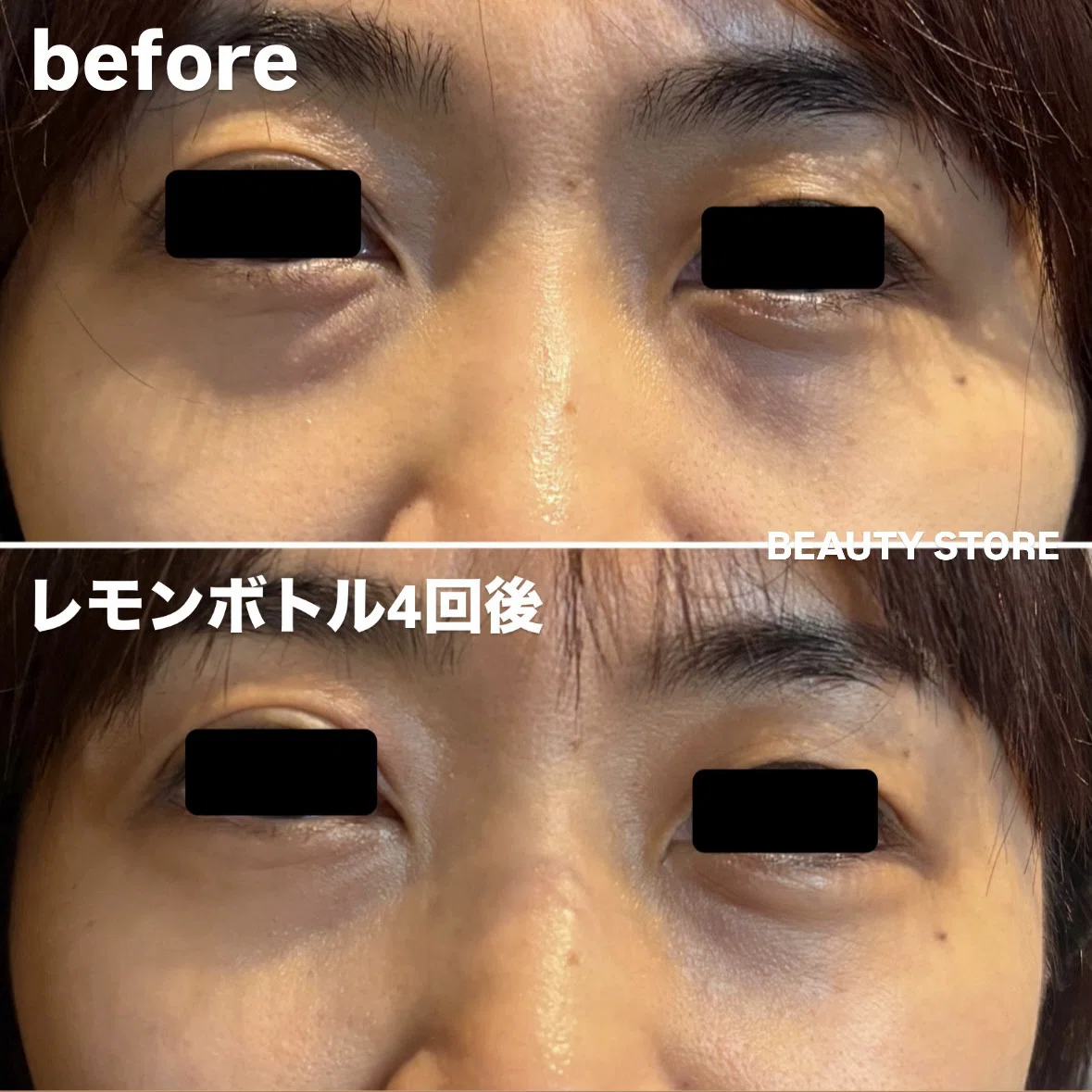 レモンボトル小顔造形before・after｜BEAUTY STOREサロンメニュー