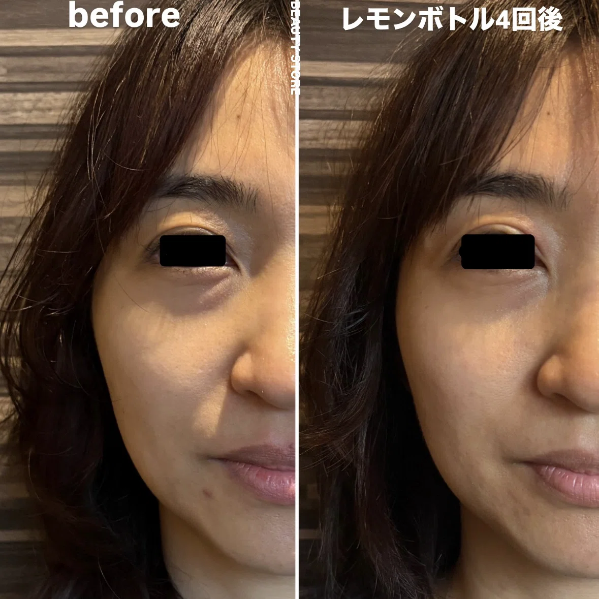 レモンボトル小顔造形before・after｜BEAUTY STOREサロンメニュー