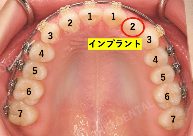 先天性欠如（先欠）とは？｜ワイヤー矯正＋インプラントで治したすきっ