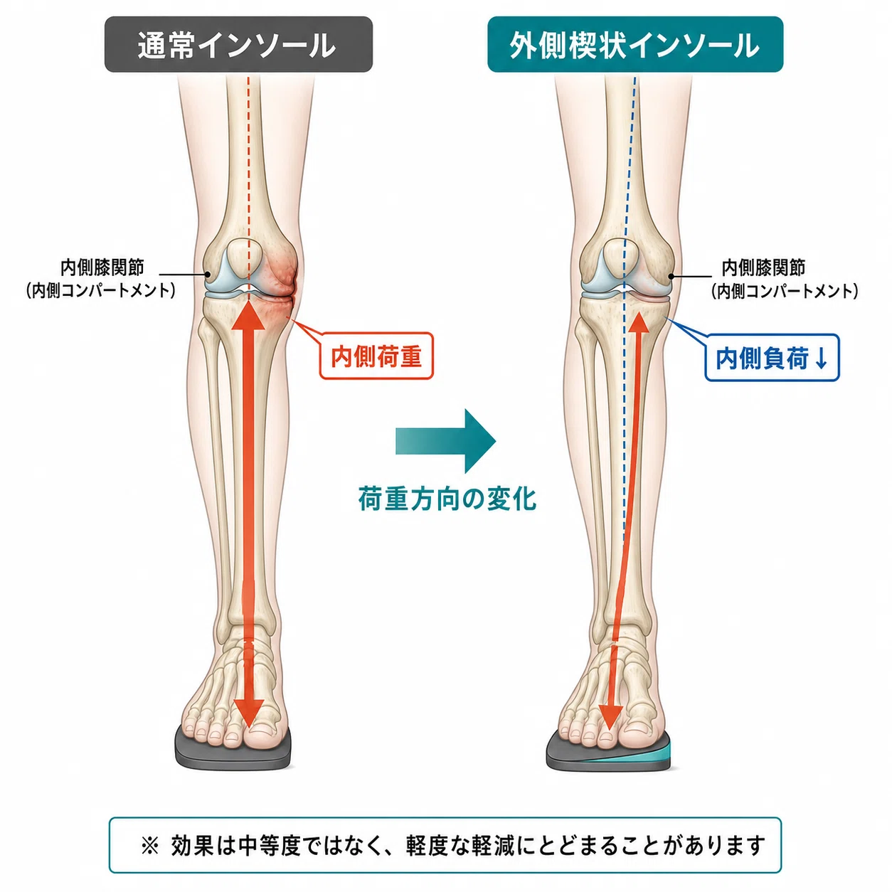 変形性膝関節症に外側ウェッジインソールをどう使うか｜神谷なおき