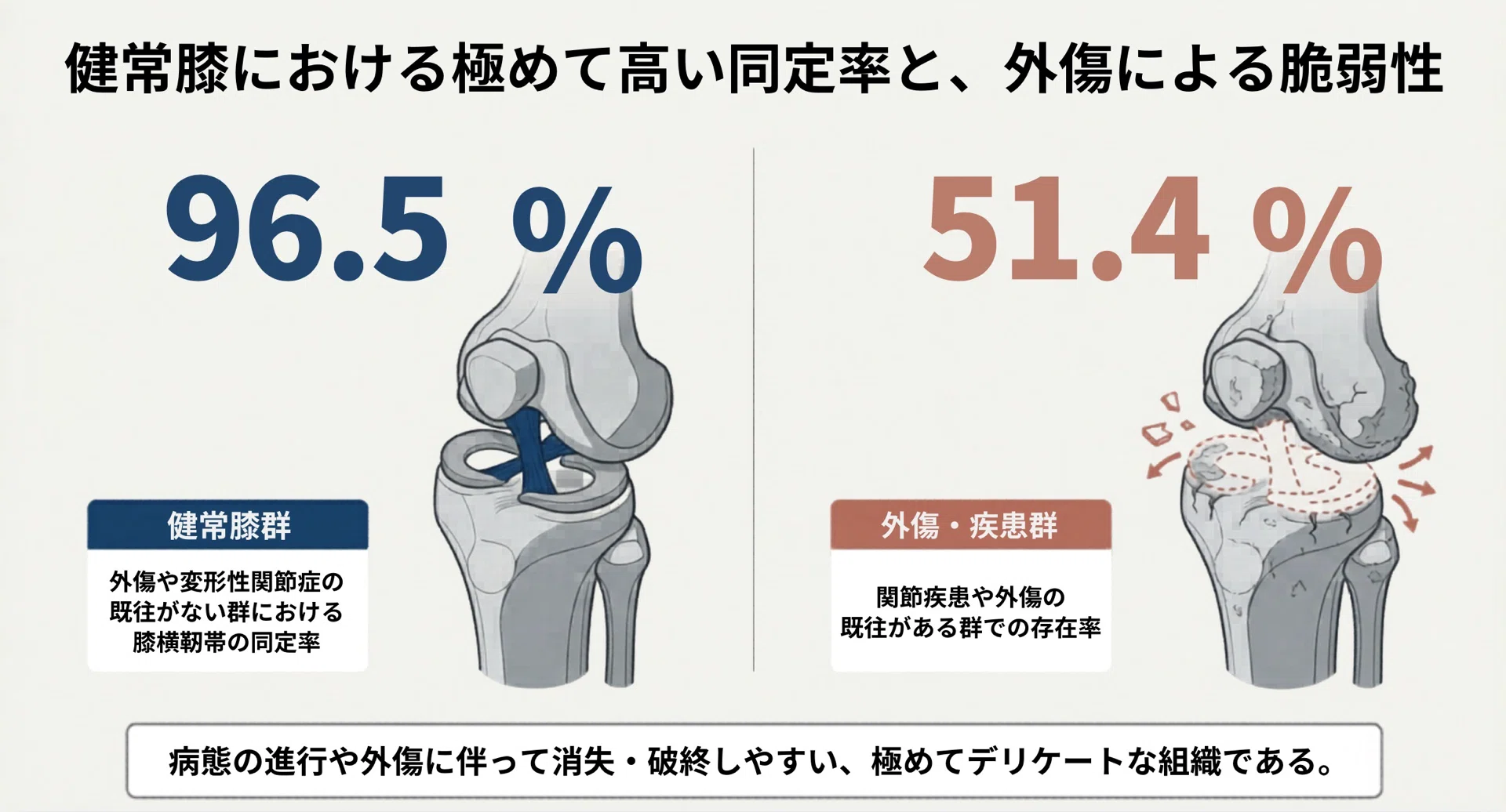 膝横靱帯｜膝神 【臨床勉強部屋】