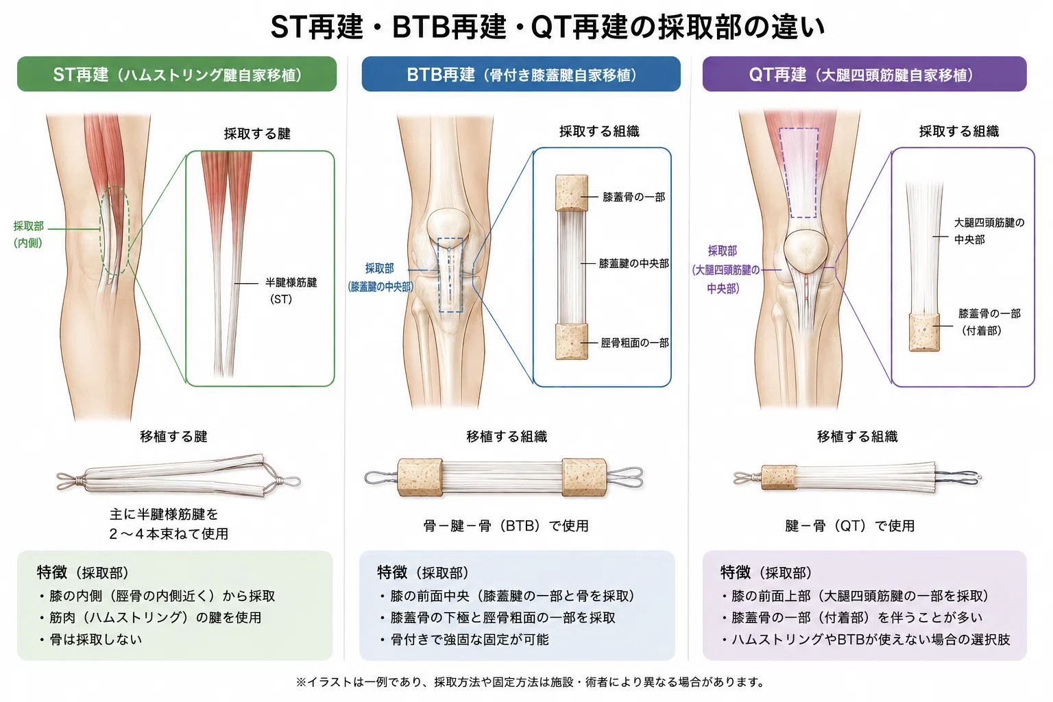 前十字靱帯の術式について｜sports_pt_ssyr