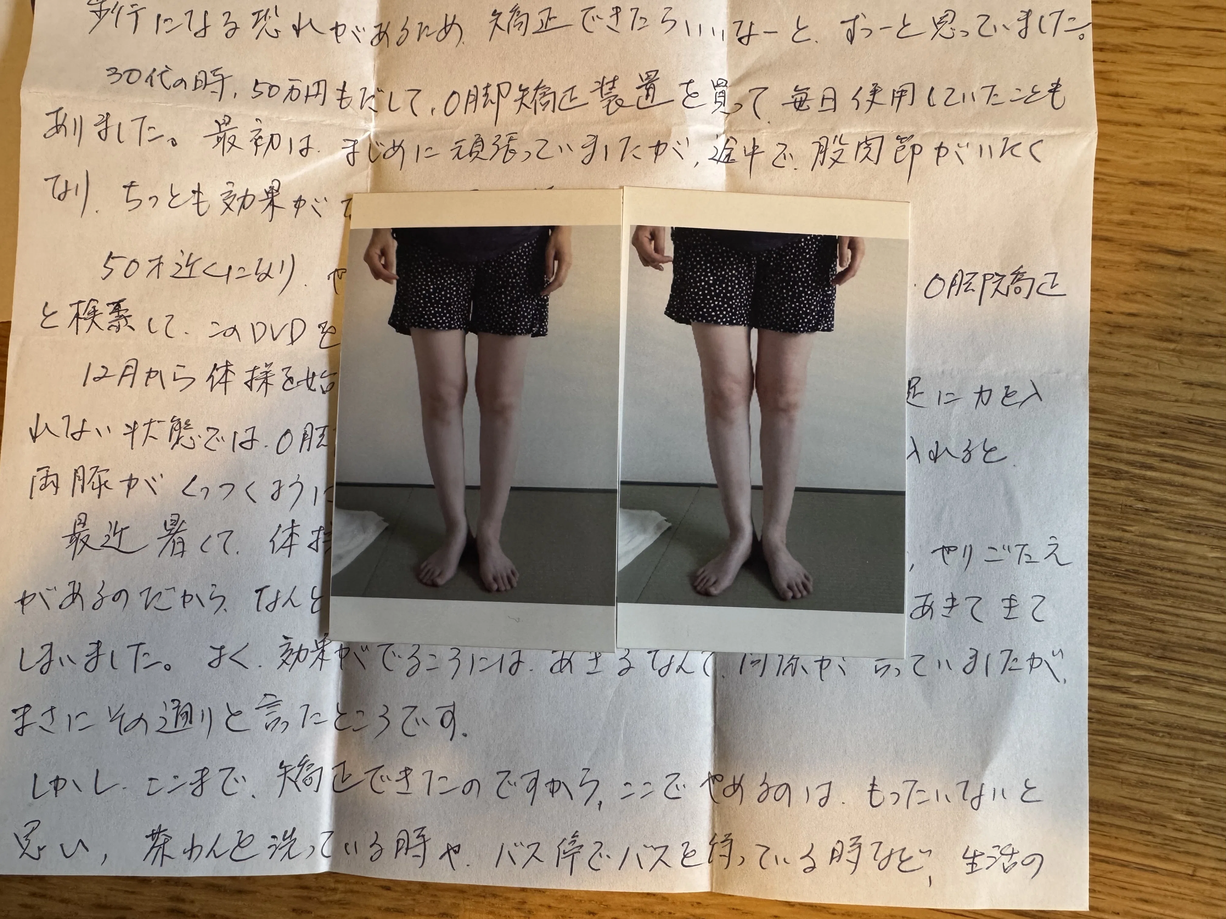 膝下O脚「父や弟がO脚で膝下O脚でもあり、この不格好な脚は遺伝のせい